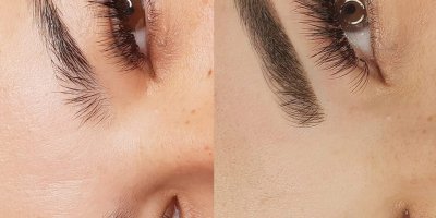 מיקרובליידינג